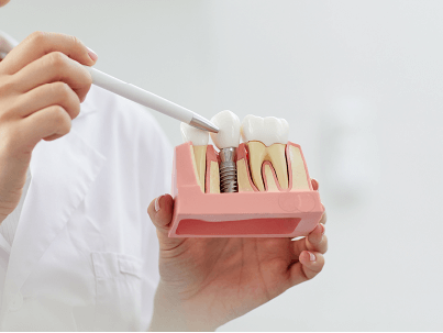implantes de carga imediata